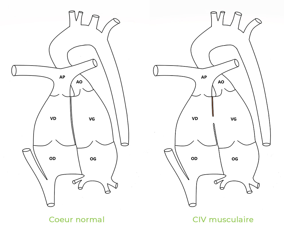 CIV musculaire