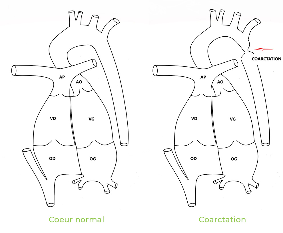 Coarctation