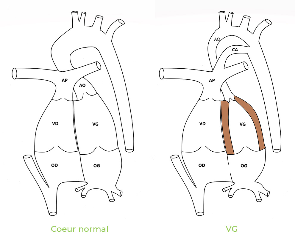 Hypo VP