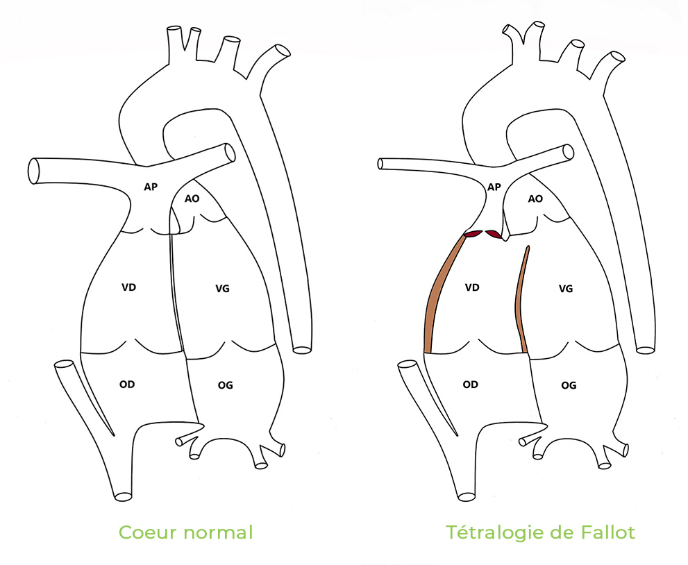 Tétralgie de fallot